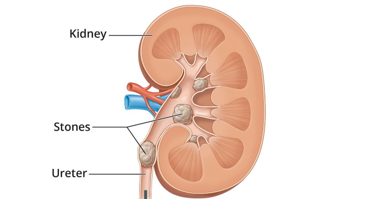 Kidney Stone? জেনে নিন কিডনিতে স্টোনের ৮টি স্পষ্ট লক্ষণ! 2 8 clear signs of kidney stones