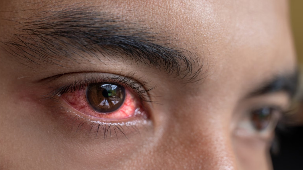Conjunctivitis